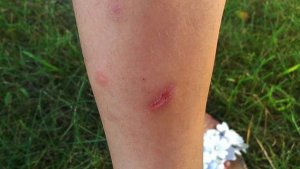 被打过狂犬疫苗的狗咬了怎么办