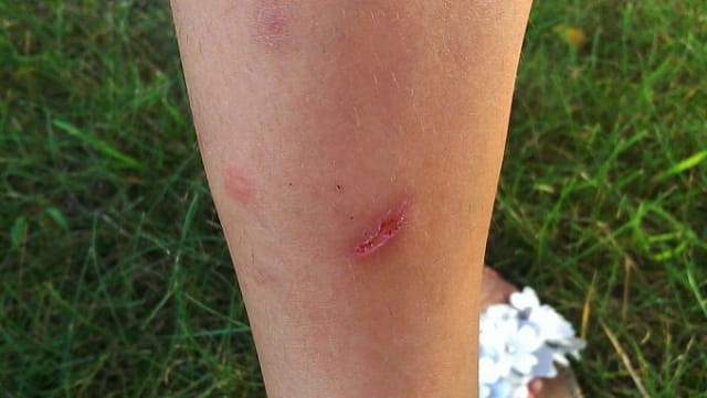 被打过狂犬疫苗的狗咬了怎么办